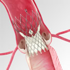 Medtronic's CoreValve in aorta