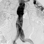 Angiogram of Endurant Stent Graft