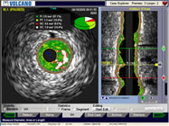 IVUS Image of coronary artery