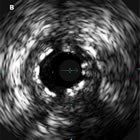 IVUS image shows stent under-expansion (click for larger image)