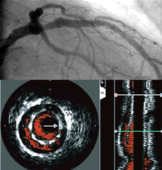 Angiography and Intravascular Ultrasound images