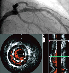 Angiogram compared to IVUS