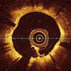 Optical Coherence Tomography (OCT) picture