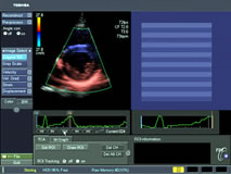 Aplio echo doppler study