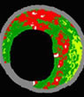 Intravascular Ultrasound