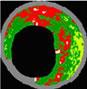 virtual histology IVUS