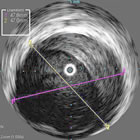 Image from Visions® PV .035 Digital IVUS Catheter