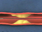 PTCA animation