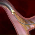 AtheroMed's Phoenix Atherectomy System