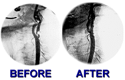 Before & After Carotid Stenting