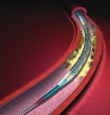 Artist's rendition of coated stent on balloon in artery
