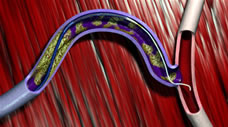 FilterWire EZ™ Embolic Protection System