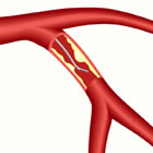 Fractional Flow Reserve (FFR) wire in coronary artery