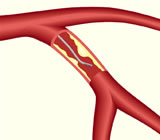 Fractional Flow Reserve wire in artery