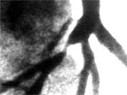 Fluoroscopic image of stenosis