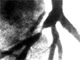 Drug Eluting Stent