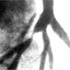 angiographic image of stenosis