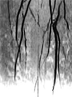 leg artery after gene therapy