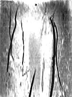 leg artery before gene therapy