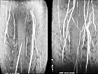 before and after gene therapy