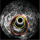 Intravascular Ultrasound Image