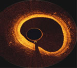 OCT Image inside right coronary artery