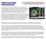 Intravascular Ultrasound