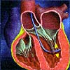 PTMR catheter positioned in left ventricle