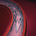 Drug Eluting Stent