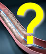 Questions About Stents