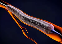 Xtent Customizable Stent