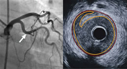 Angiography vs. IVUS image of plaque disruption
