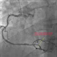 RCA angiogram