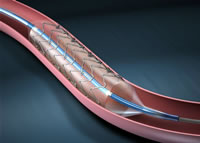 XIENCE V™ Everolimus Eluting Coronary Stent System