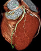 Cardiac CT Image