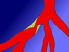 plaque build-up in left coronary artery